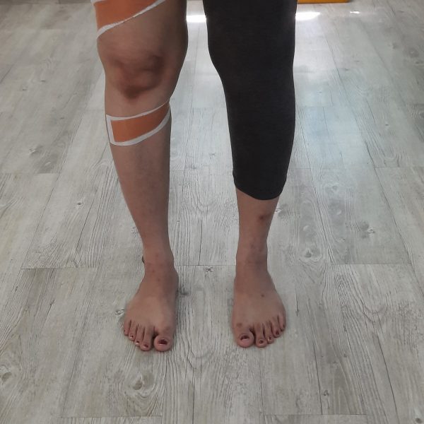 taping techniques